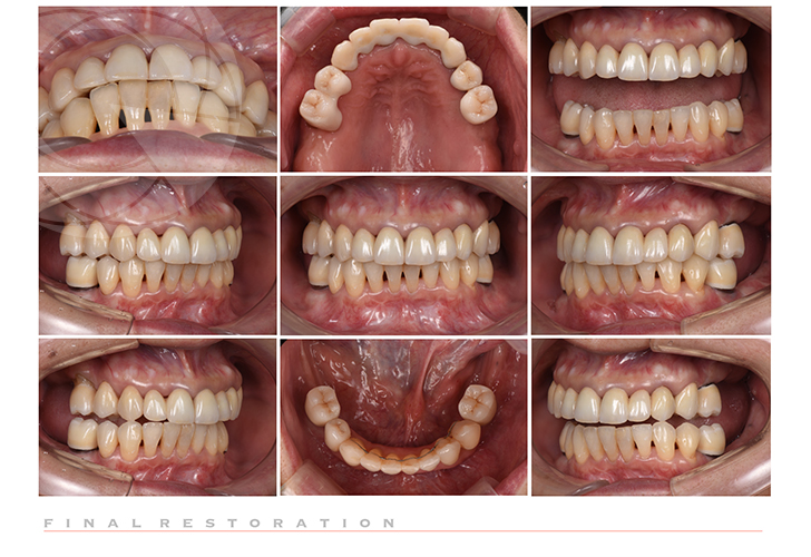 矯正治療とインプラント補綴を併用した咬合再構成