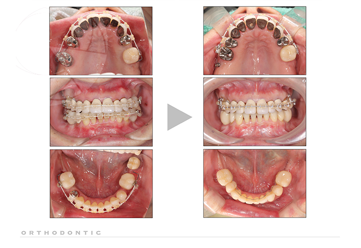 矯正治療とインプラント補綴を併用した咬合再構成
