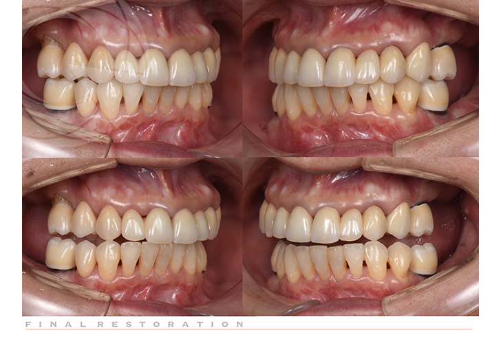 矯正治療とインプラント補綴を併用した咬合再構成